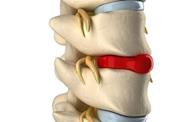 Protrusión discal: diferencias con la hernia y por qué la fisioterapia es clave