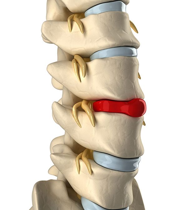 Protrusión discal: diferencias con la hernia y por qué la fisioterapia es clave