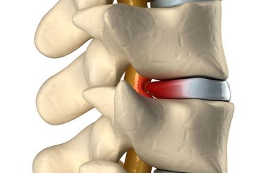 Ciática por hernia discal: síntomas, tratamiento y cuándo dejar de sufrir