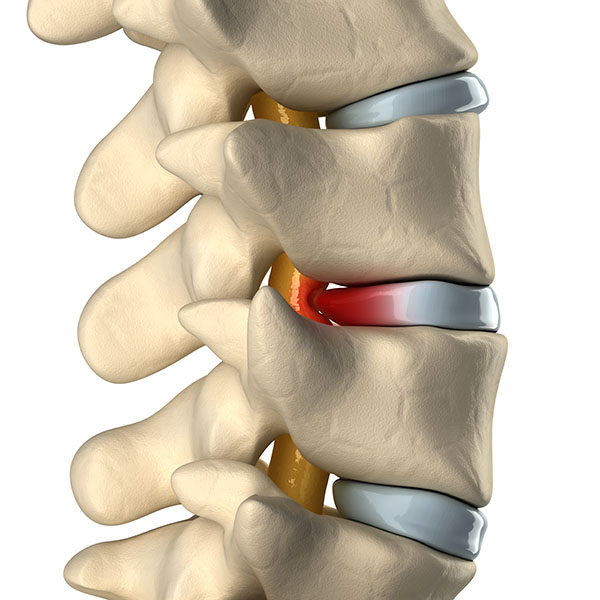 hernia discal compresión ciática fisioterapia Fidoos Madrid Vallecas