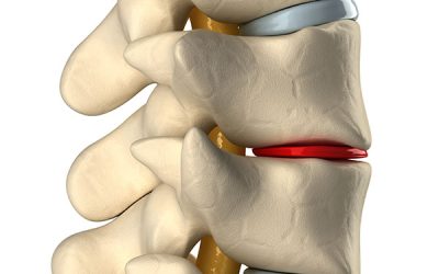 Pinzamiento discal: cuando el disco se aplasta y qué puede hacer la fisioterapia