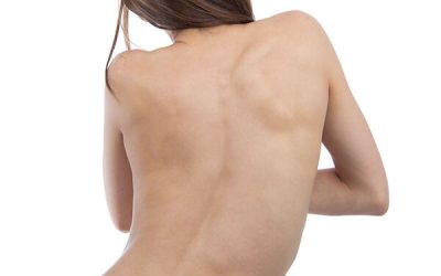 Escoliosis en adolescentes: cómo detectarla y tratarla a tiempo
