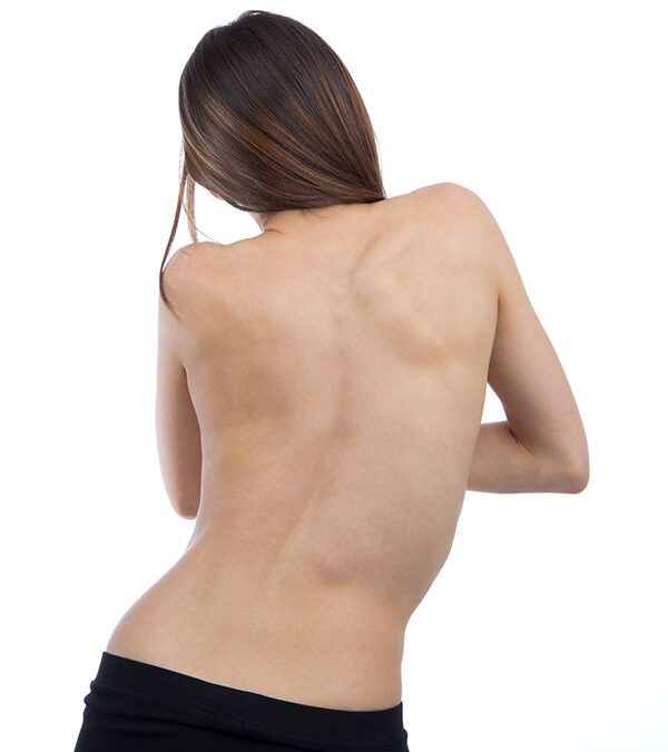 Escoliosis en adolescentes: cómo detectarla y tratarla a tiempo