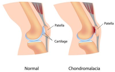 Lesiones de rodilla en fútbol amateur: ligamentos, menisco y tendón