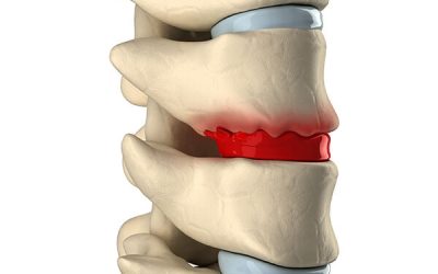 Hernia discal: cuando el frío de otoño dispara el dolor